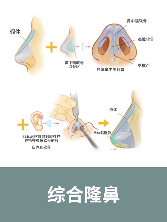 综合隆鼻.jpg