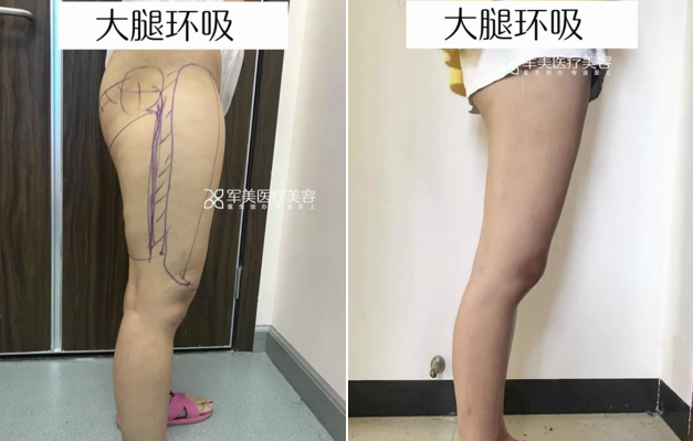 大腿环吸.png