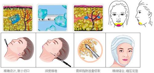 面部吸脂原理图