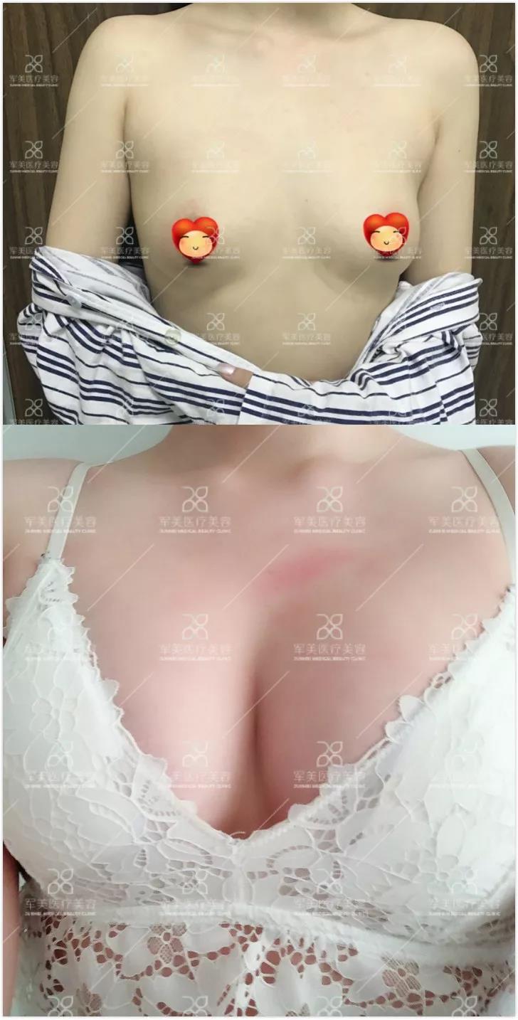 自体脂肪丰胸