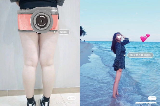 抽脂减肥