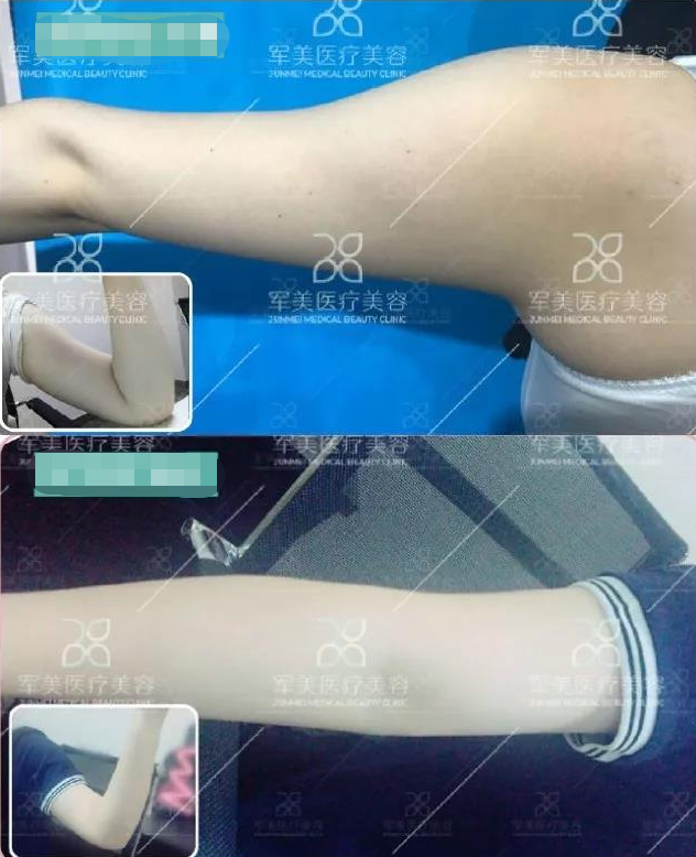 手臂抽脂