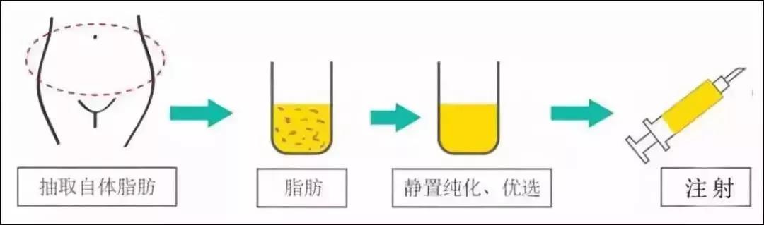 自体脂肪填充面部