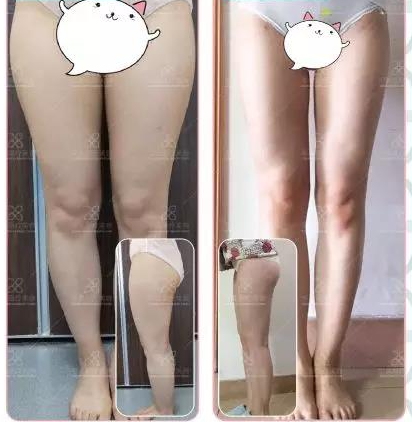 大腿吸脂后多久能消肿