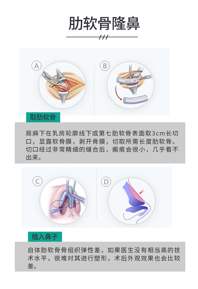 自体肋软骨隆鼻价格