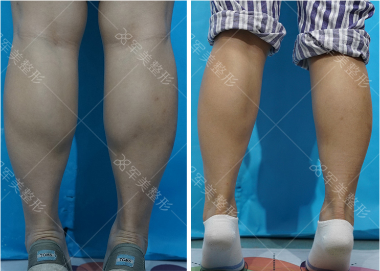 瘦腿针安全吗