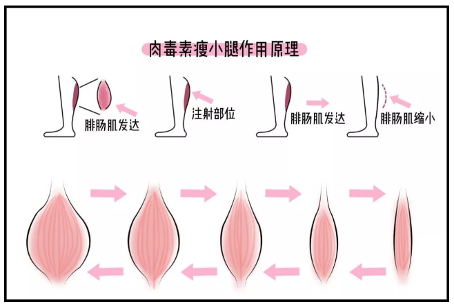 小腿粗怎么办