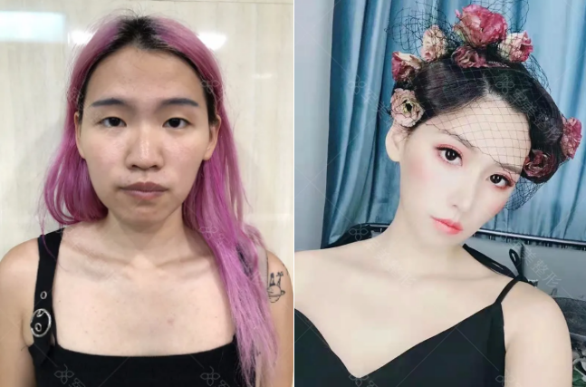 王世虎隆鼻