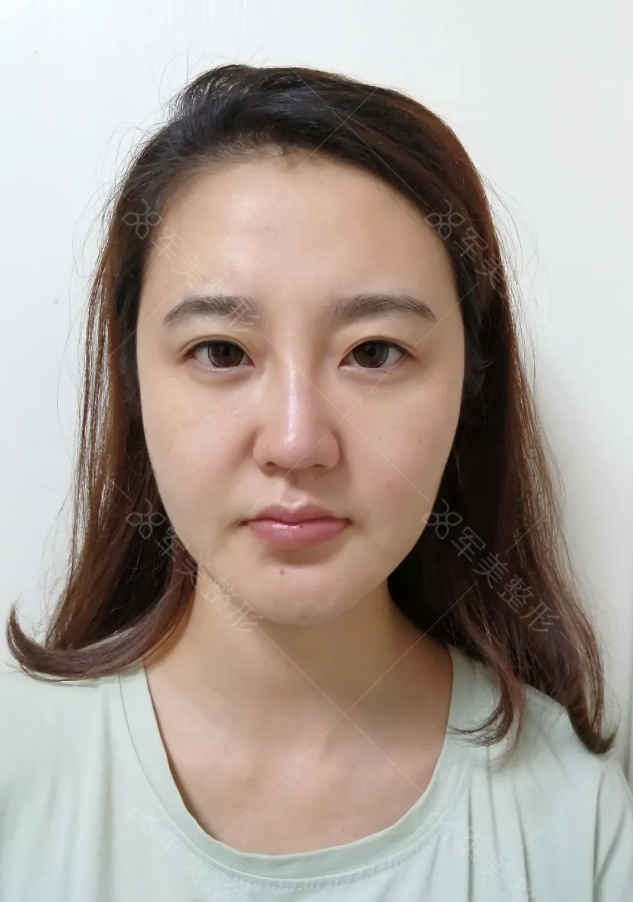自体脂肪填充面部
