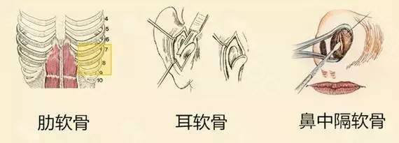 耳软骨隆鼻