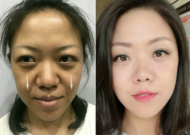 自体脂肪填充面部