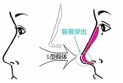 隆鼻大概得需要多少钱