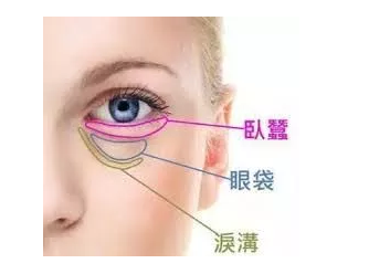 泪沟怎么消除