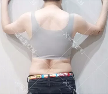 哪家减肥抽脂好