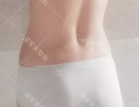 腰腹吸脂
