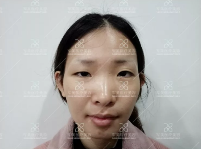 割双眼皮哪家医院好