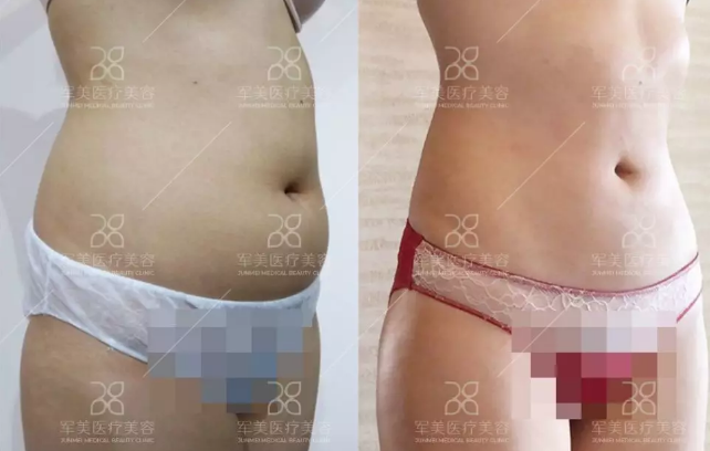 腰腹吸脂减肥真实案例