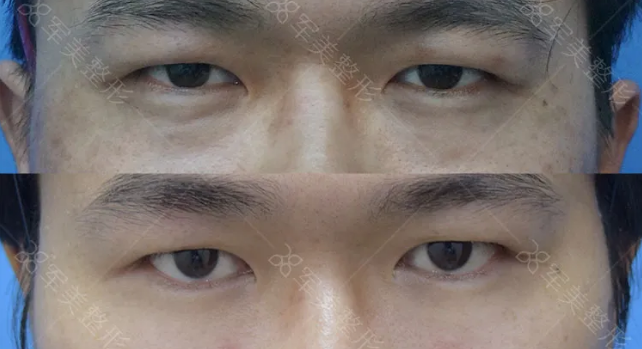 自体脂肪填充
