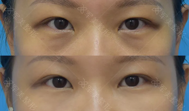 自体脂肪填充