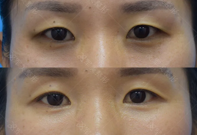 自体脂肪填充