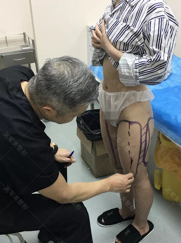 大腿吸脂减肥术效果好不好