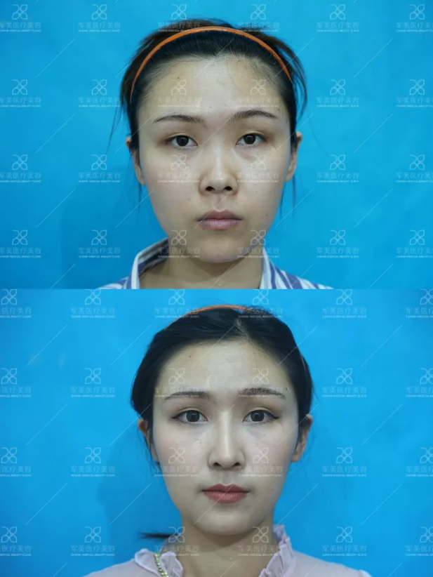 假体隆鼻和肋骨鼻哪个好