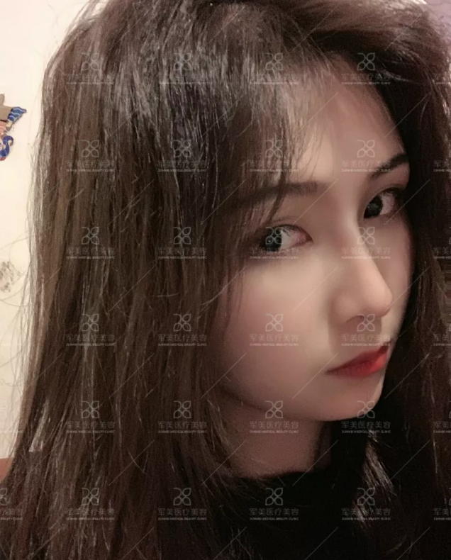 假体隆鼻和肋骨鼻哪个好