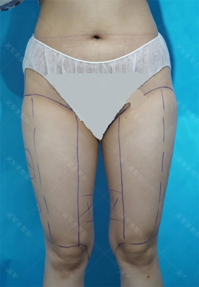 大腿吸脂多久开始变细