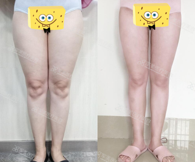 吸脂减肥