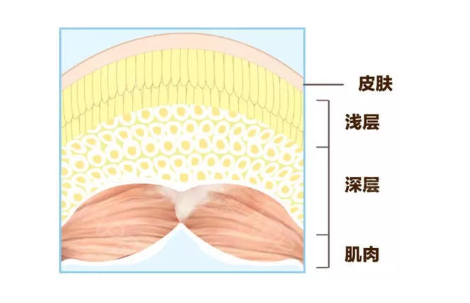 吸脂减肥