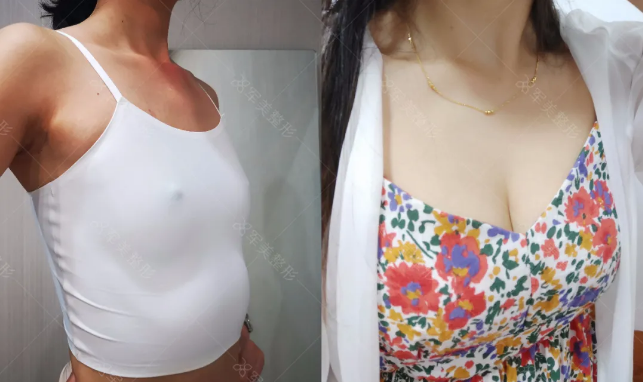自体脂肪隆胸