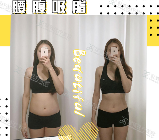 腰腹吸脂减肥术