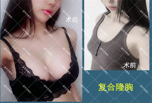 复合隆胸