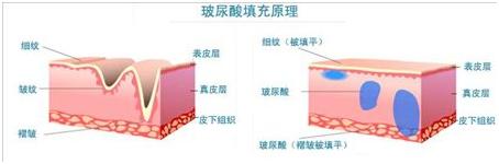 玻尿酸隆鼻