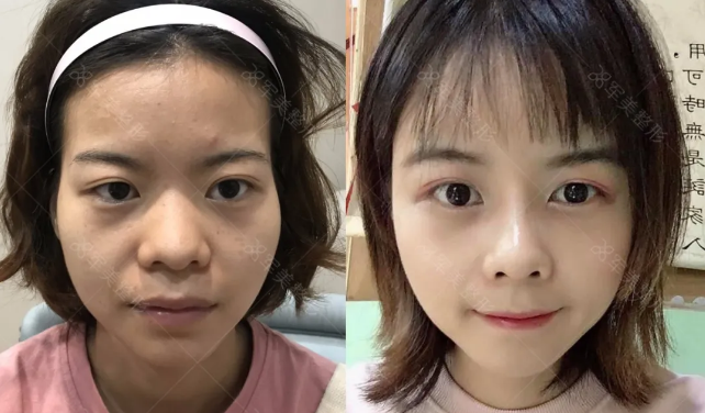 自体脂肪填充