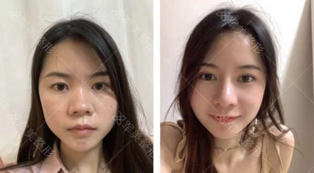 自体肋软骨隆鼻