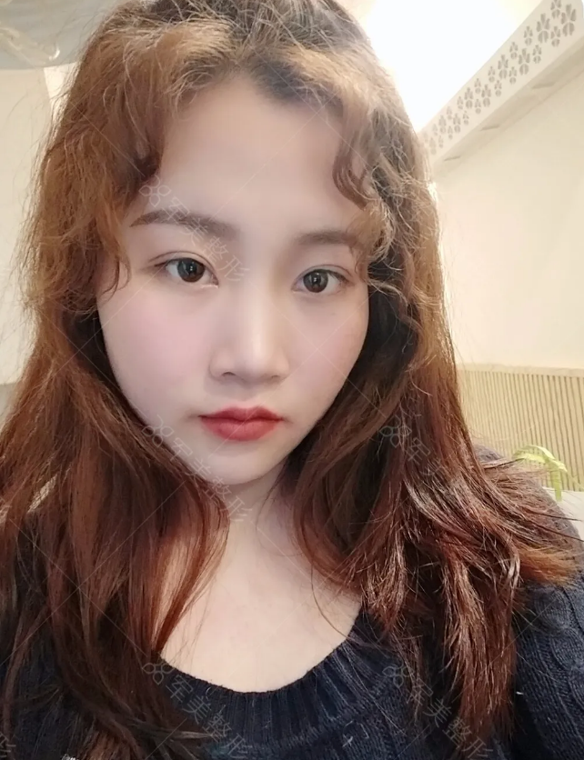 割双眼皮对比图