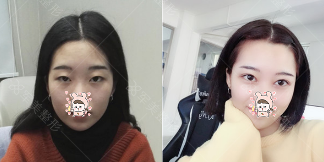 双眼皮