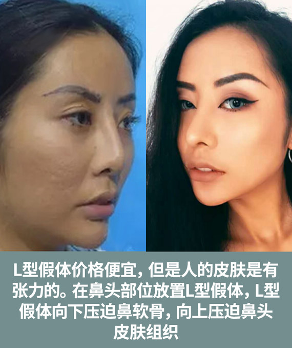 鼻修复.png