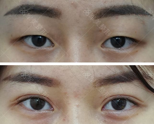 做双眼皮有几种方法