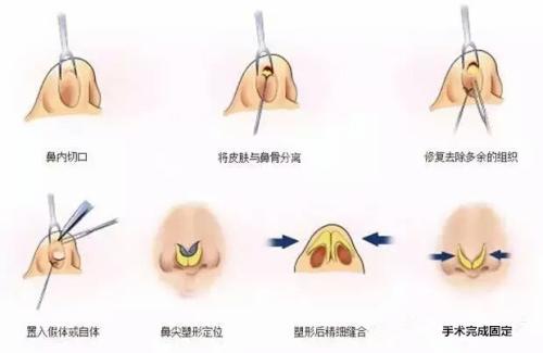 隆鼻过程示图