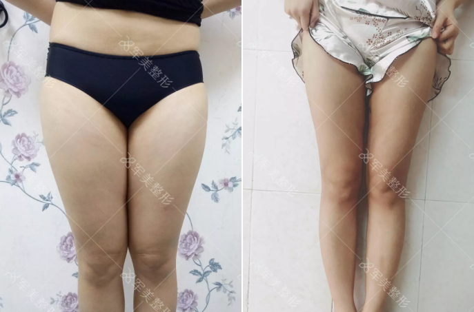 大腿抽脂术前注意事项有哪些