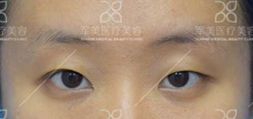 做双眼皮有几种方法