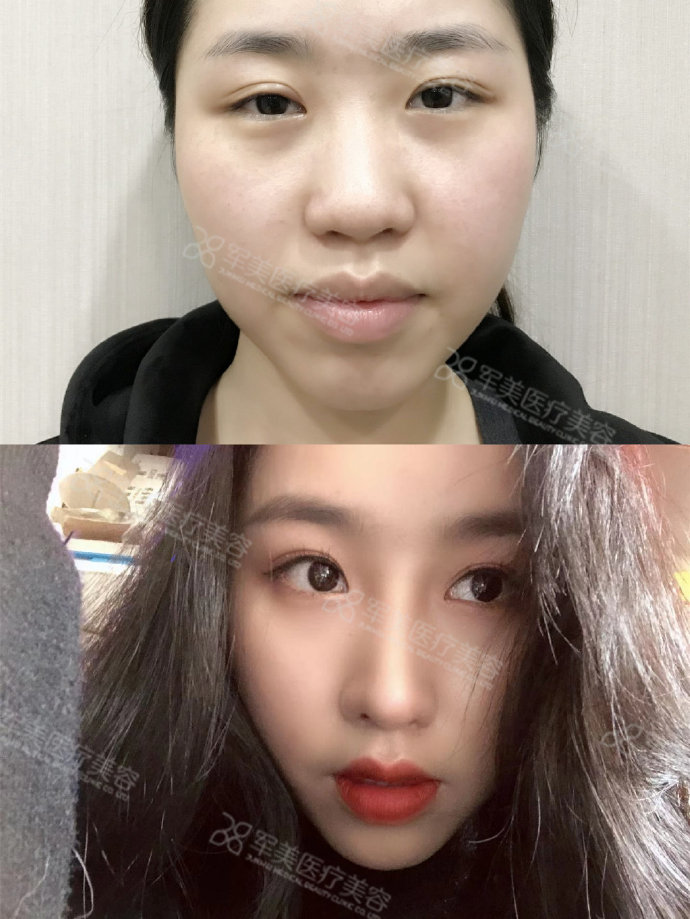 隆鼻子哪种效果好