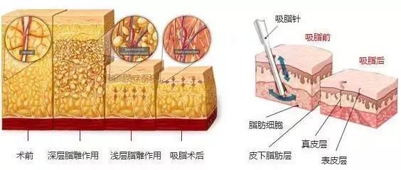 吸脂减肥术