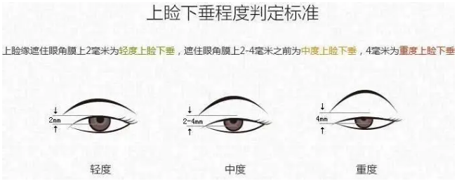 眼综合手术包括什么项目
