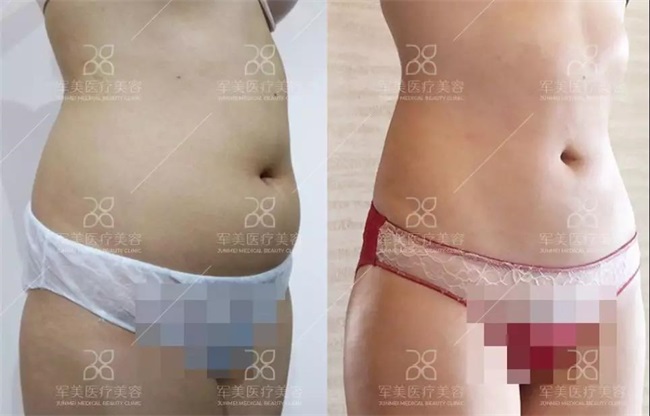 抽脂减肥