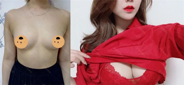 自体脂肪丰胸好还是假体好
