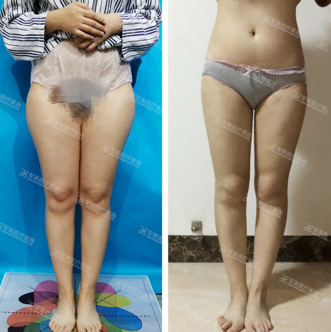 吸脂瘦腿