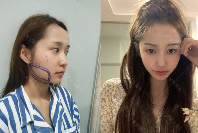 面部抽脂效果